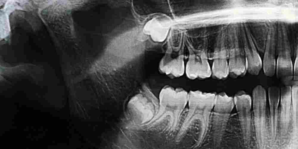 What to Expect Before, During, and After Wisdom Tooth Extraction
