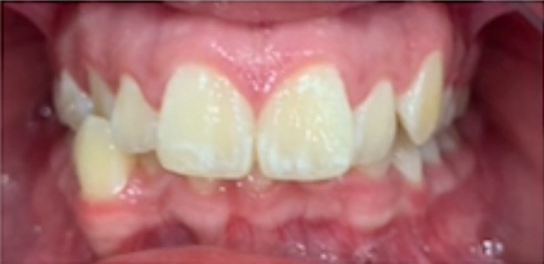 braces before 2