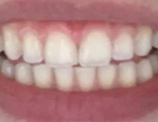 Teeth Whitening after